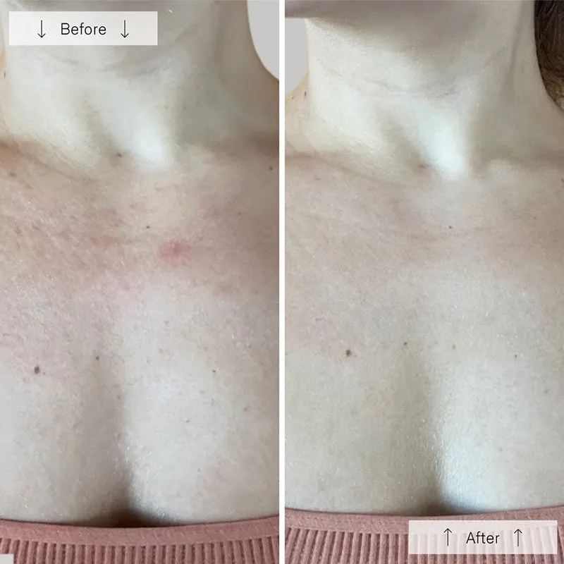 OMNILUX | Contour Neck & Décolleté